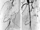 Wieder im Fluss: Nach einem Verschluss der Kniearterie (l) kann das Blut nach einer Laser-Angioplastie wieder fließen (r). Foto: Prof. Hermann Josef Steinkamp Wieder im Fluss: Nach einem Verschluss der Kniearterie (l) kann das Blut nach einer Laser-Angioplastie wieder fließen (r). Foto: Prof. Hermann Josef Steinkamp
