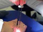 Mit einem Laser lassen sich Tätowierungen heute entfernen. Wie gut das gelingt, hängt auch von der Farbe des Tattoos ab. Foto: Jörg Donecker/dpa-tmn Mit einem Laser lassen sich Tätowierungen heute entfernen. Wie gut das gelingt, hängt auch von der Farbe des Tattoos ab. Foto: Jörg Donecker/dpa-tmn